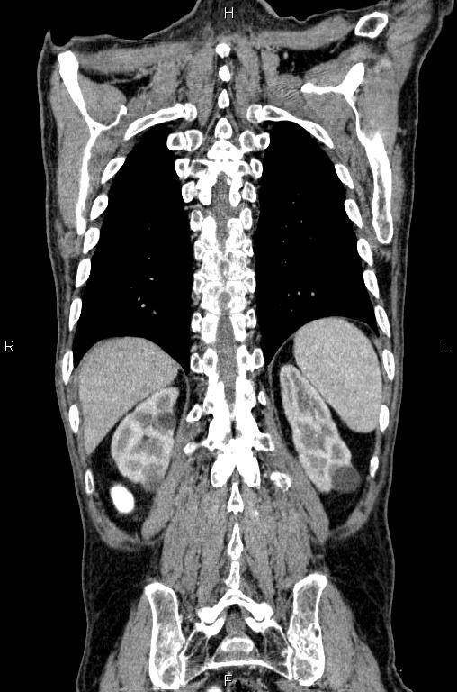 Ampullary adenocarcinoma (Radiopaedia 86093-102033 D 50).jpg