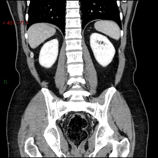 Ampullary carcinoma (Radiopaedia 56396-63056 E 70).jpg