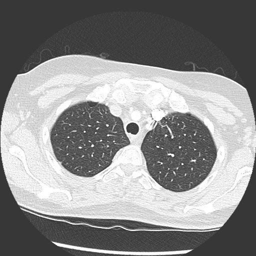 Amyloidosis - bronchial and diffuse nodular pulmonary involvement (Radiopaedia 60156-67745 Axial lung window 13).jpg