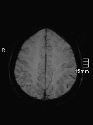 File:Amyotrophic lateral sclerosis (Radiopaedia 70821-81017 Axial SWI minIP 37).jpg