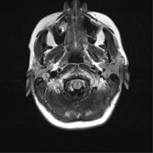 File:Anaplastic astrocytoma - thalamic glioma (Radiopaedia 59709-67115 Axial FLAIR 1).png