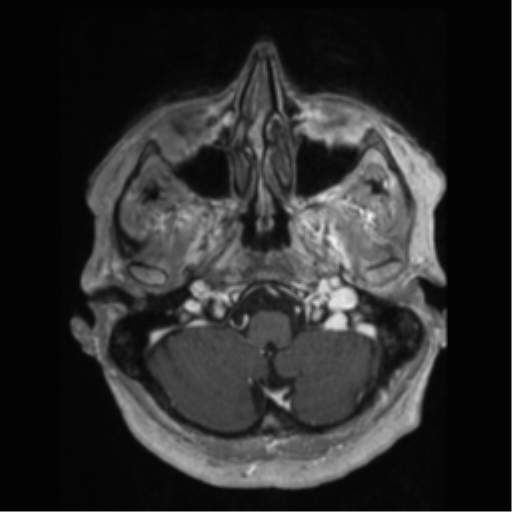 File:Anaplastic astrocytoma IDH wild-type (pseudoprogression) (Radiopaedia 42209-45277 Axial T1 C+ 15).png