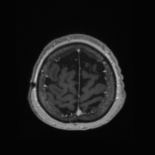 Anaplastic astrocytoma IDH wild-type (pseudoprogression) (Radiopaedia 42209-45278 Axial T1 C+ 133).png