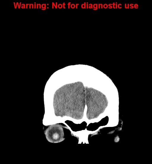 File:Anaplastic ganglioglioma (Radiopaedia 44921-48815 Coronal non-contrast 5).jpg