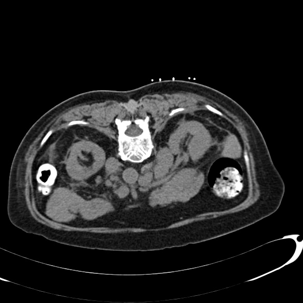 File:Anaplastic lymphoma - with CT biopsy (Radiopaedia 21643-21602 Axial non-contrast 22).jpg