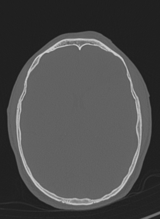 Anaplastic oligodendroglioma with skull fracture (Radiopaedia 74831-85846 Axial bone window 27).png