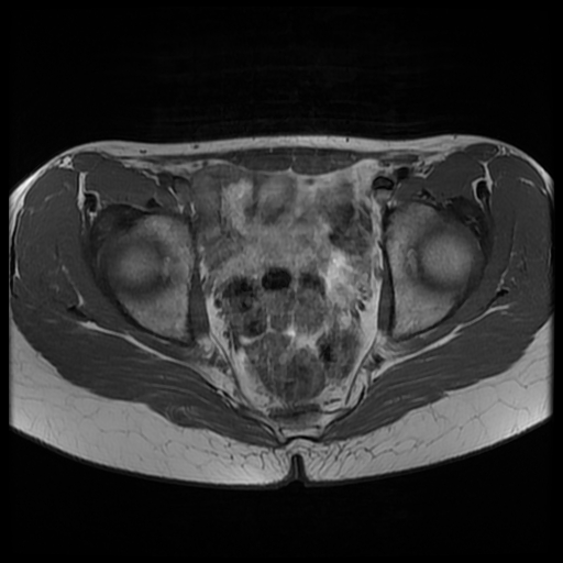 File:Androgen insensitivity syndrome (Radiopaedia 38585-40727 Axial T1 15).jpg