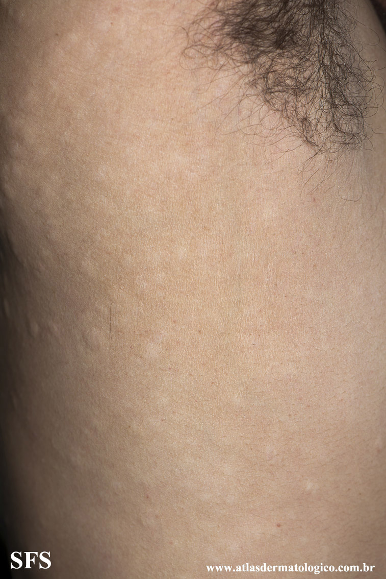 Anetoderma Jadassohn Pellizari (Dermatology Atlas 38).jpg