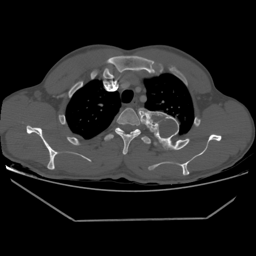 Aneurysmal bone cyst - rib (Radiopaedia 82167-96220 Axial bone window 77).jpg