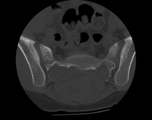 Aneurysmal bone cyst - sacrum (Radiopaedia 65190-74195 Axial bone window 24).jpg