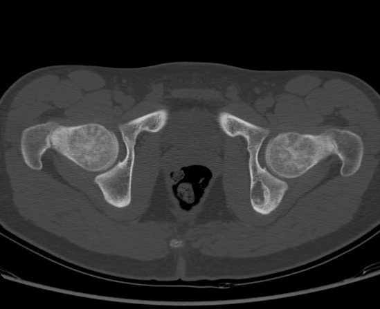 File:Aneurysmal bone cyst of ischium (Radiopaedia 25957-26094 Axial bone window 63).png