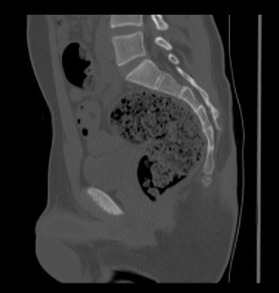 Aneurysmal bone cyst of ischium (Radiopaedia 25957-26094 Sagittal bone window 36).png