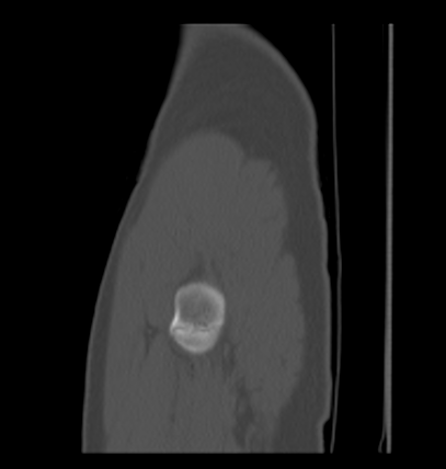 File:Aneurysmal bone cyst of ischium (Radiopaedia 25957-26094 Sagittal bone window 4).png