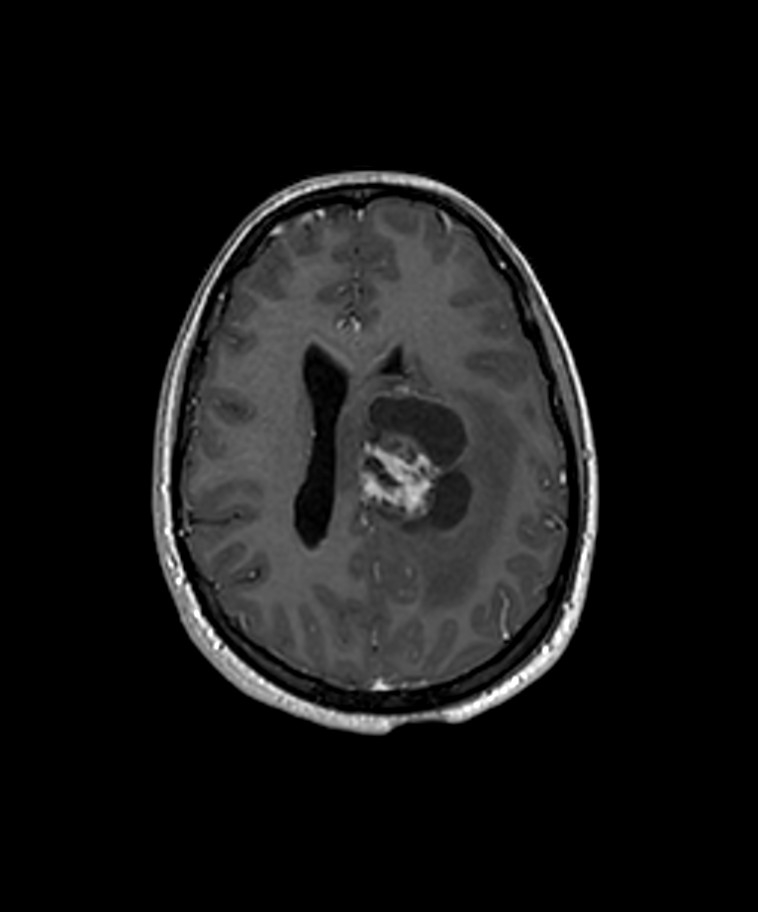 Angiomatous meningioma (Radiopaedia 79459-92577 Axial T1 C+ 3D ISO 20).jpg