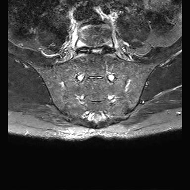 File:Ankylosing spondylitis with zygapophyseal arthritis (Radiopaedia 38433-40517 D 7).jpg