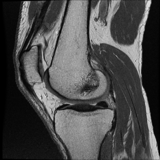 Anomalous insertion of the medial meniscus (Radiopaedia 77559-89721 Sagittal PD 33).jpg