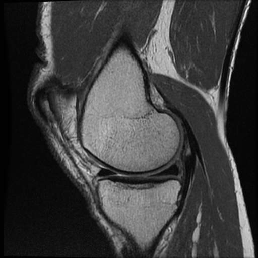 Anomalous insertion of the medial meniscus (Radiopaedia 77559-89721 Sagittal PD 38).jpg