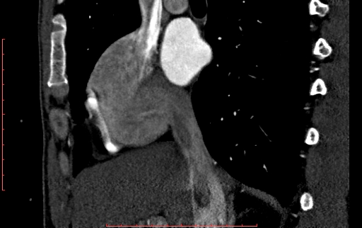 File:Anomalous left coronary artery from the pulmonary artery (ALCAPA) (Radiopaedia 70148-80181 C 41).jpg