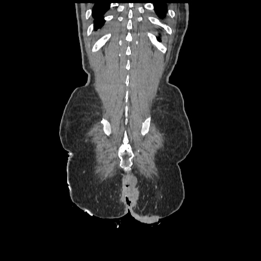 Anorectal carcinoma (Radiopaedia 44413-48064 B 83).jpg