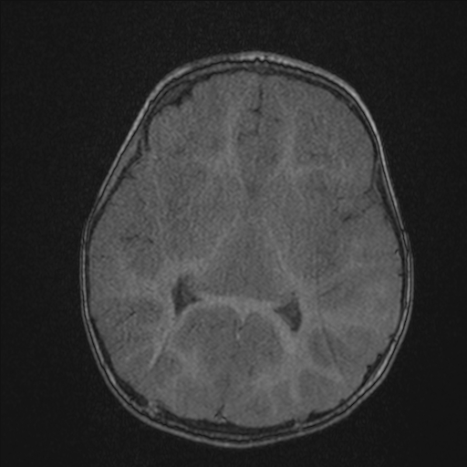 Anoxic brain injury (Radiopaedia 79165-92139 Axial MRA 125).jpg