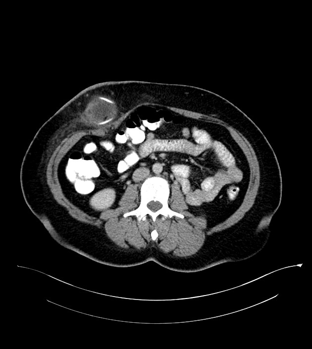 Anterior abdominal wall CSF pseudocyst (CSFoma) (Radiopaedia 79453-92571 A 49).jpg