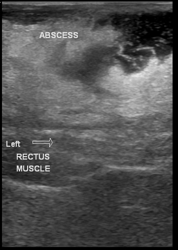 File:Anterior abdominal wall abscess (Radiopaedia 17732-17480 E 1).jpg