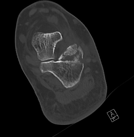 Anterior calcaneal process fracture (Radiopaedia 63353-71943 Axial bone window 97).jpg