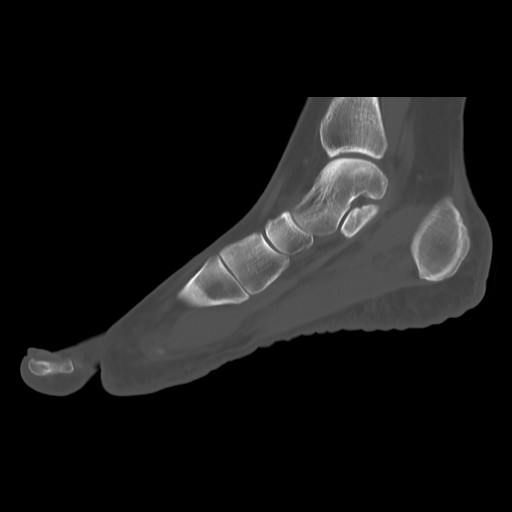 File:Anterior calcaneal process fracture (Radiopaedia 82590-96762 Sagittal bone window 10).jpg
