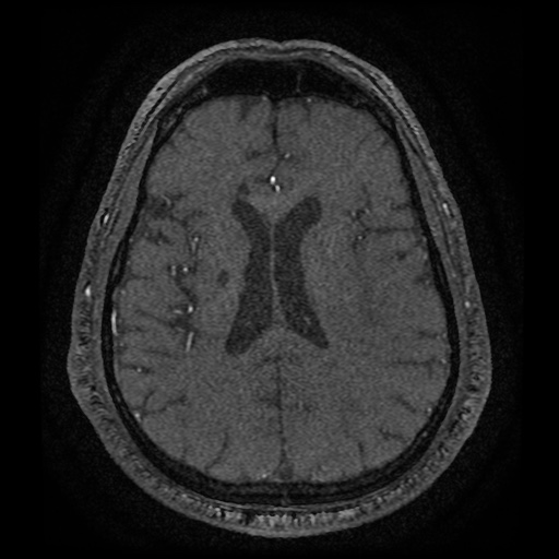 Anterior cerebral artery infarction (Radiopaedia 46794-51323 Axial MRA 138).jpg