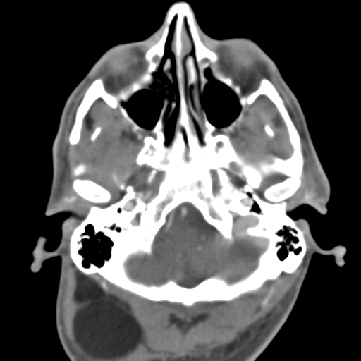 File:Anterior cerebral artery territory infarct (Radiopaedia 39327-41581 B 48).png