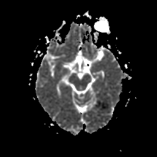 File:Anterior cerebral artery territory infarct (Radiopaedia 39327-41584 Axial ADC 10).png