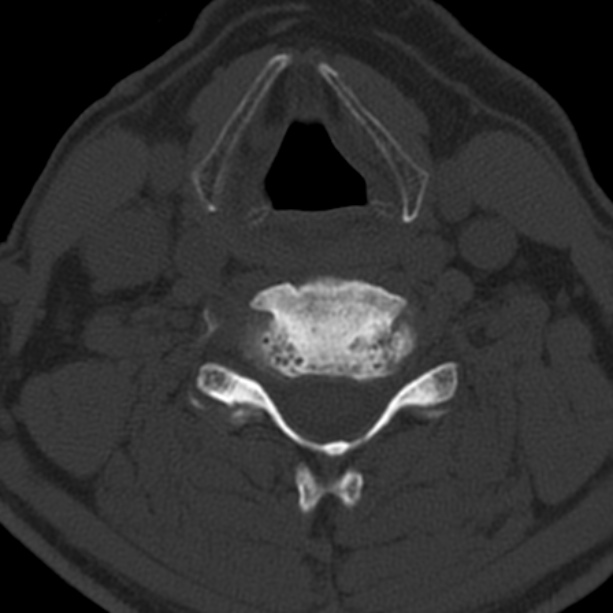 Anterior cervical postdiscectomy arthrodesis (Radiopaedia 32678-33646 Axial bone window 46).jpg