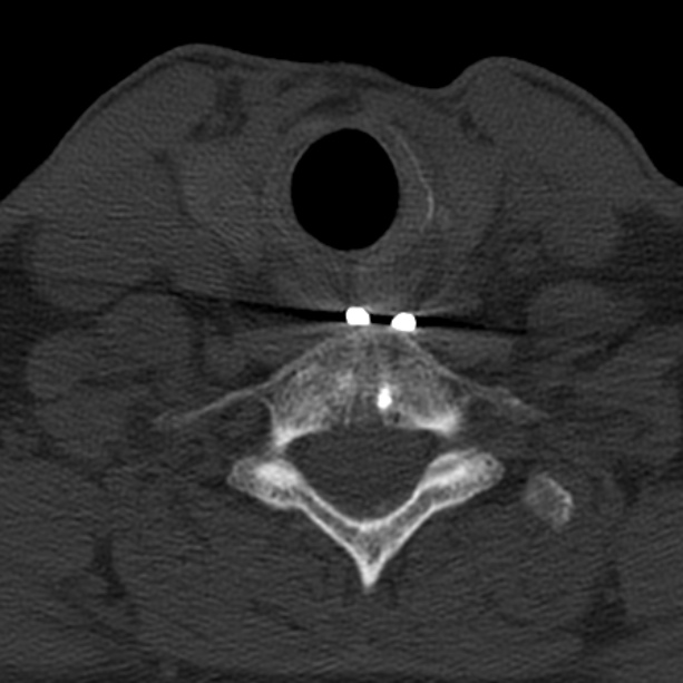 Anterior cervical postdiscectomy arthrodesis (Radiopaedia 32678-33646 Axial bone window 59).jpg