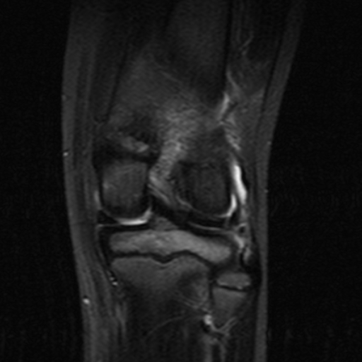 File:Anterior cruciate ligament avulsion fracture (Radiopaedia 24710-24974 Coronal STIR 9).jpg