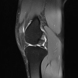 File:Anterior cruciate ligament full thickness tear (Radiopaedia 66268-75467 Sagittal PD fat sat 10).jpg