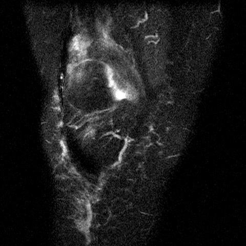 File:Anterior cruciate ligament mucoid degeneration (Radiopaedia 60853-68633 Coronal STIR 10).jpg