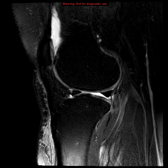 File:Anterior cruciate ligament tear (Radiopaedia 12329-12612 E 7).jpg