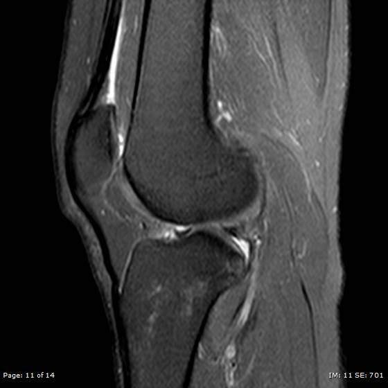 File:Anterior cruciate ligament tear (Radiopaedia 70783-80964 Sagittal PD fat sat 11).jpg