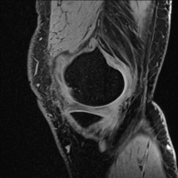 Anterior cruciate ligament tear - ramp lesion (Radiopaedia 71883-82322 Sagittal T1 vibe 116).jpg