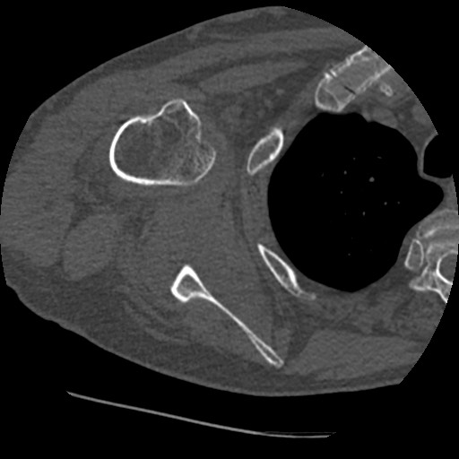 Anterior glenohumeral dislocation with Hill-Sachs lesion (Radiopaedia 62877-71249 Axial bone window 52).jpg