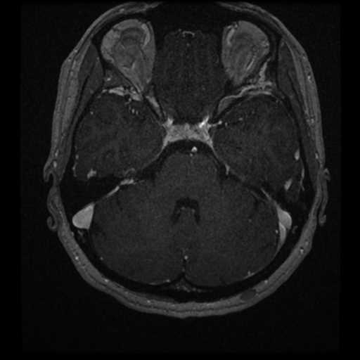 Anterior inferior cerebellar artery vascular loop - type II (Radiopaedia 70991-81209 Axial T1 C+ 23).jpg