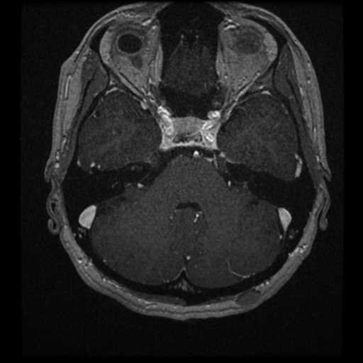 Anterior inferior cerebellar artery vascular loop - type II (Radiopaedia 70991-81209 Axial T1 C+ 35).jpg