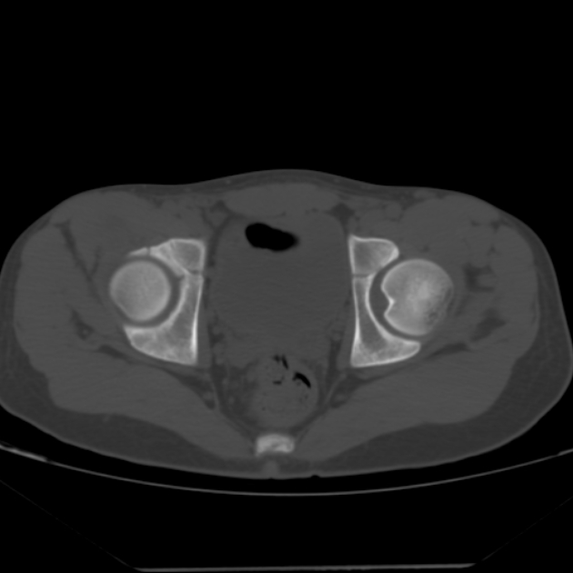 Anterior inferior iliac spine avulsion fracture (Radiopaedia 49469-54627 Axial bone window 38).jpg