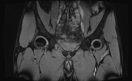 Anterior inferior iliac spine avulsion fracture (Radiopaedia 81312-95000 G 63).jpg