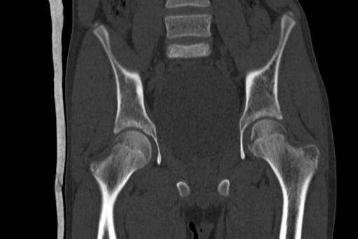 Anterior inferior iliac spine avulsion injury (Radiopaedia 88666-105376 Coronal bone window 36).jpg