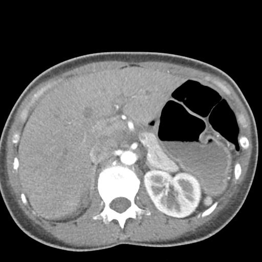 File:Anterior mediastinal lymphoma (Radiopaedia 29556-30061 C 59).jpg