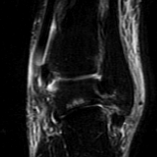File:Anterior talofibular ligament rupture (Radiopaedia 15831-15484 Coronal STIR 15).jpg