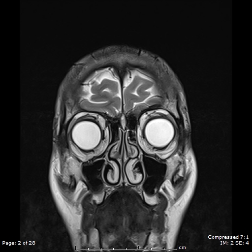 File:Anterior temporal lobe perivascular space (Radiopaedia 88283-104914 Coronal T2 2).jpg