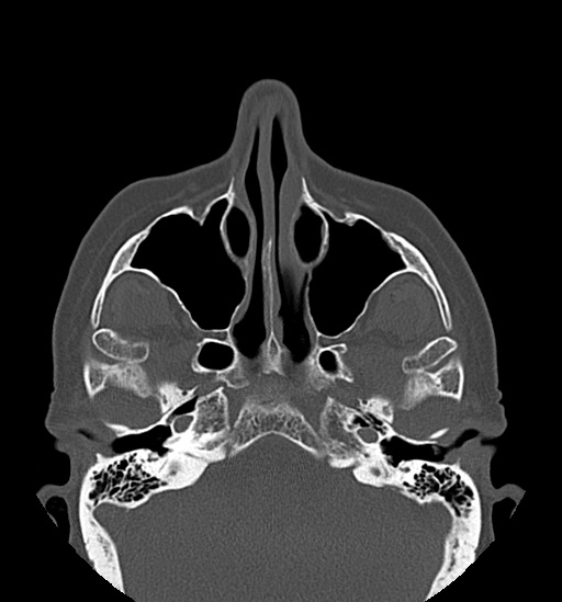 Anterior temporomandibular joint dislocation (Radiopaedia 59430-66784 Axial non-contrast 14).jpg