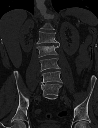 File:Anterior vertebral scalloping (abdominal aortic aneurysm) (Radiopaedia 66744-76067 Coronal bone window 36).jpg